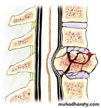 Spine Fractures