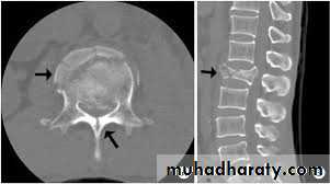 Spine Fractures