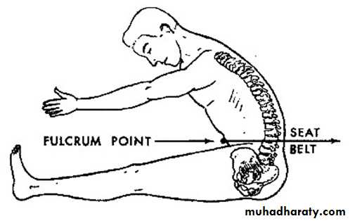 Spine Fractures
