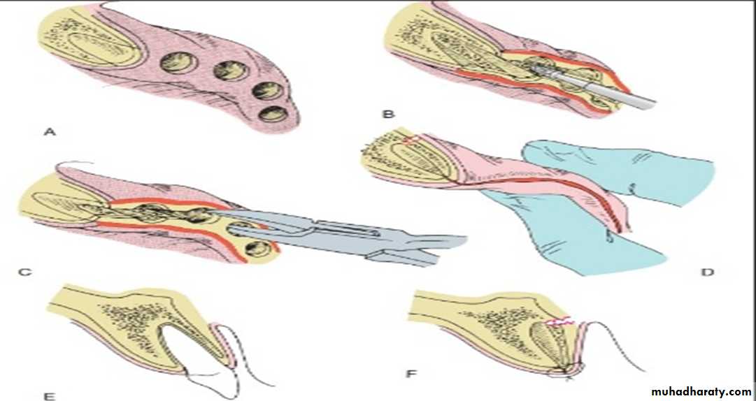 Pre-prosthetic Surgery