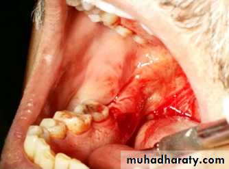 Pre-prosthetic Surgery