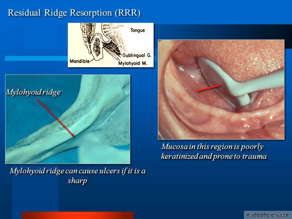 Pre-prosthetic Surgery