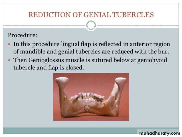 Pre-prosthetic Surgery