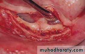 Pre-prosthetic Surgery