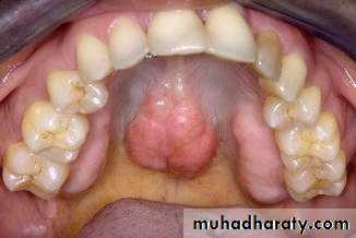 Pre-prosthetic Surgery