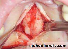 Pre-prosthetic Surgery