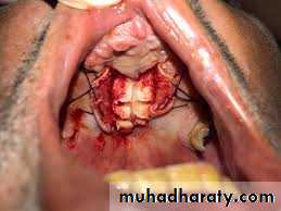 Pre-prosthetic Surgery