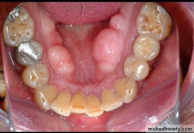 Pre-prosthetic Surgery