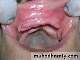 Pre-prosthetic Surgery