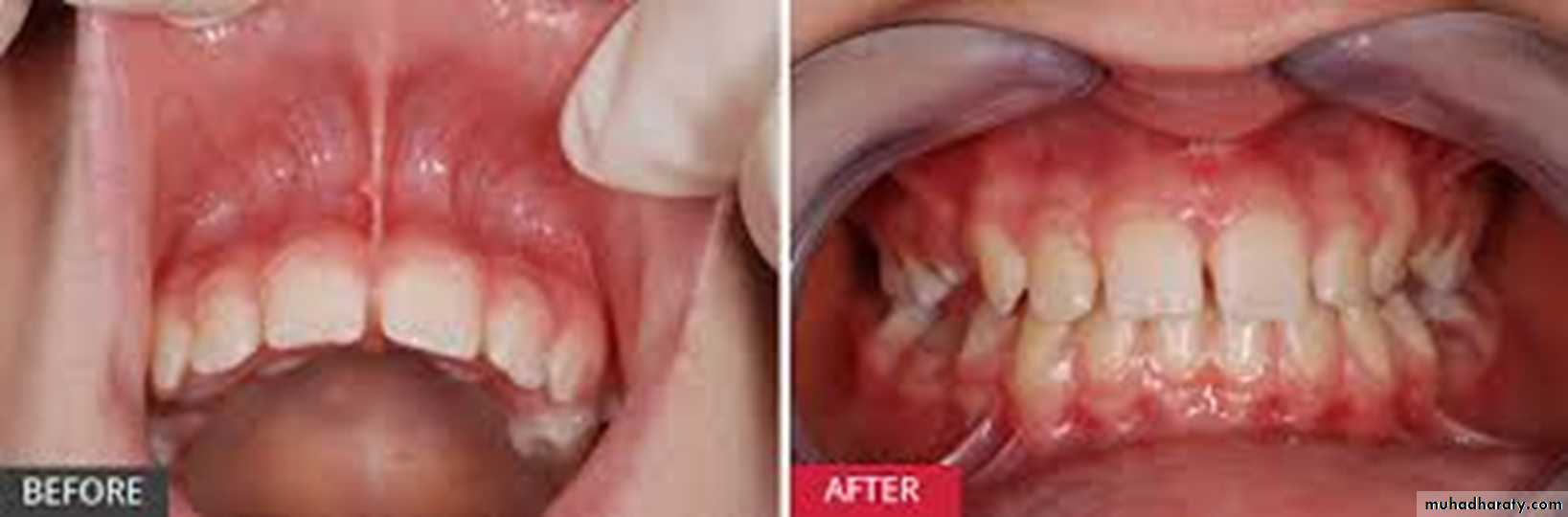 Pre-prosthetic Surgery