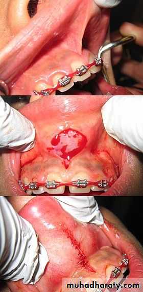Pre-prosthetic Surgery