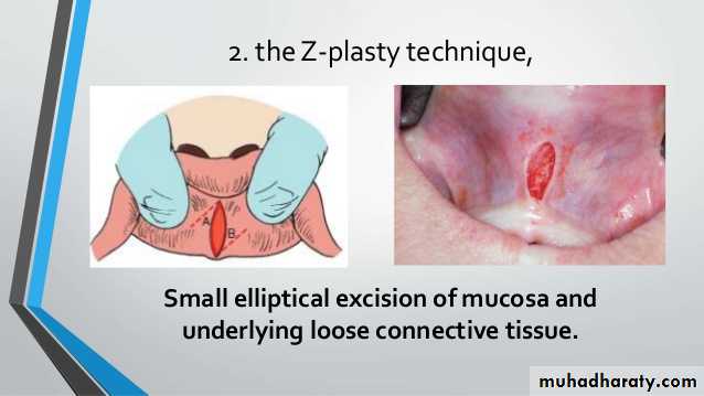 Pre-prosthetic Surgery