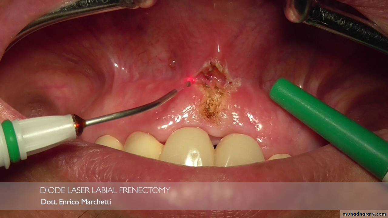 Pre-prosthetic Surgery