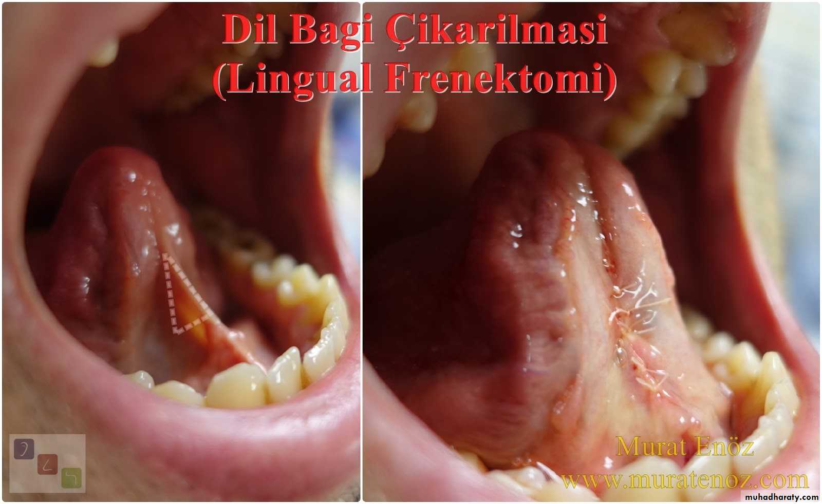 Pre-prosthetic Surgery