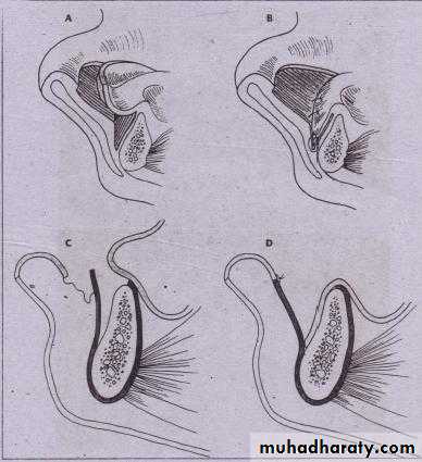 Pre-prosthetic Surgery