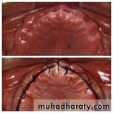 Pre-prosthetic Surgery