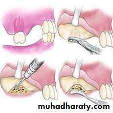 Pre-prosthetic Surgery