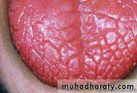 (Xerostomia (saliva