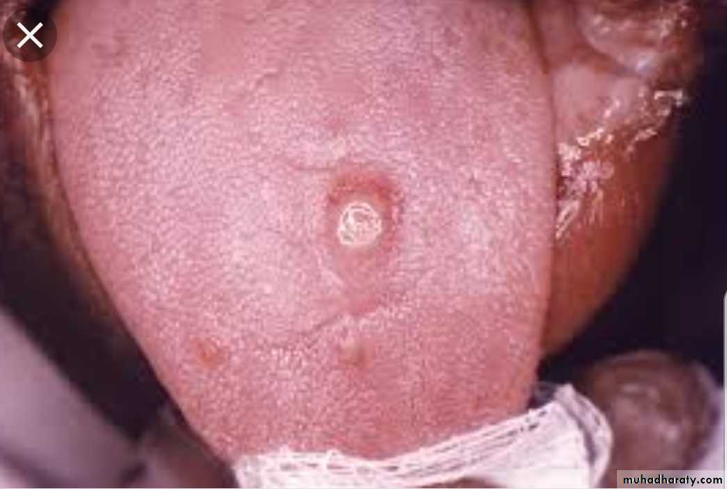 Infection