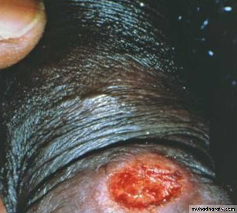 Infection