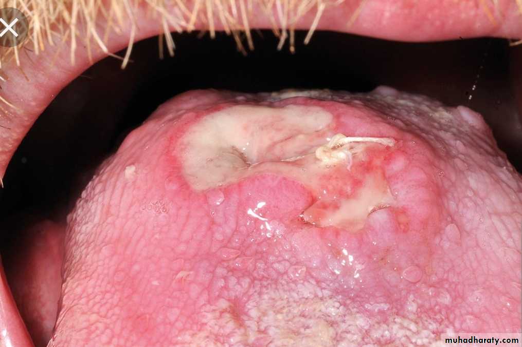 Infection