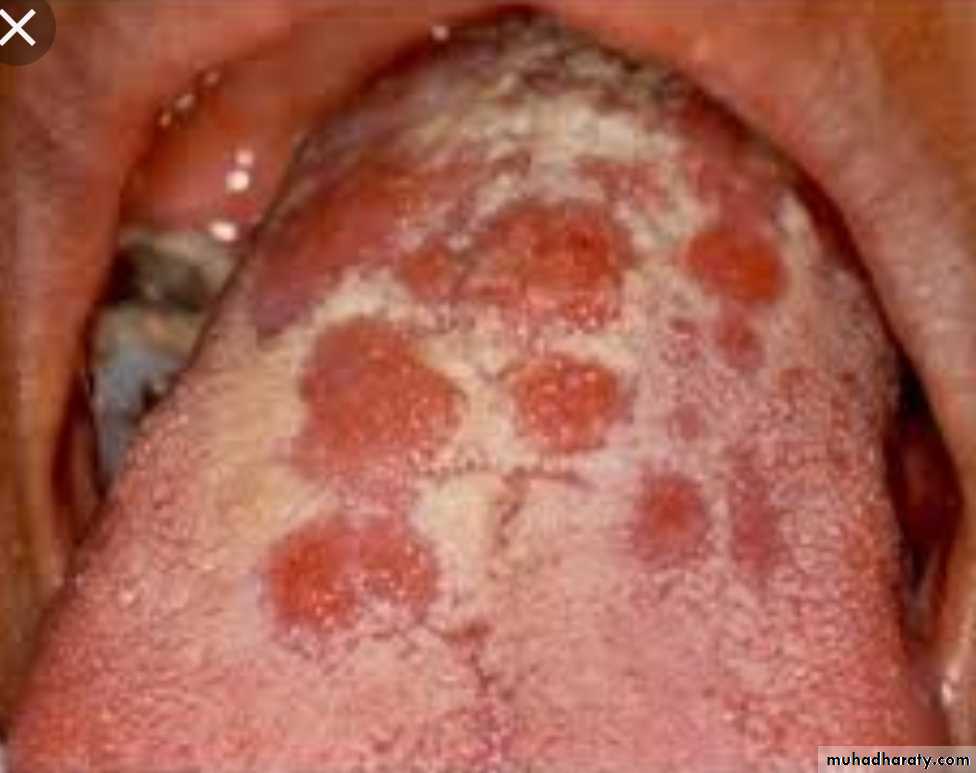 Infection