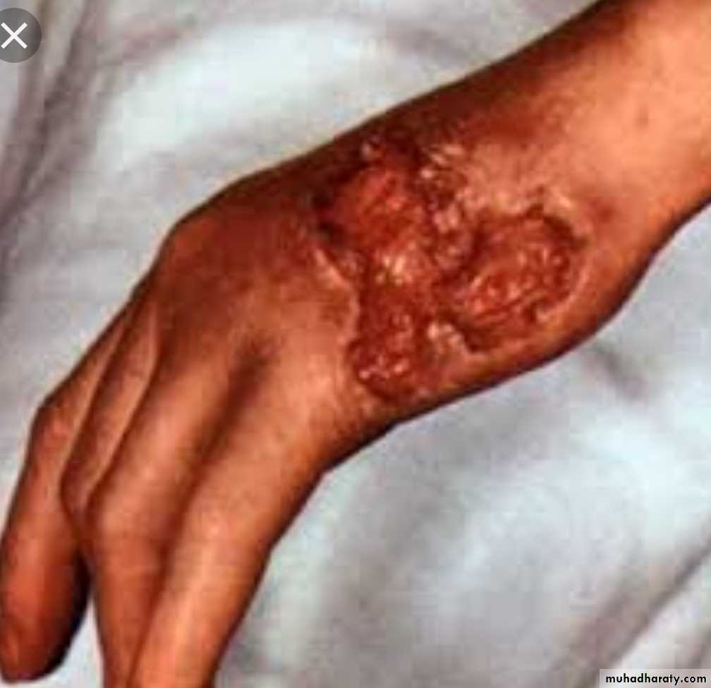Infection