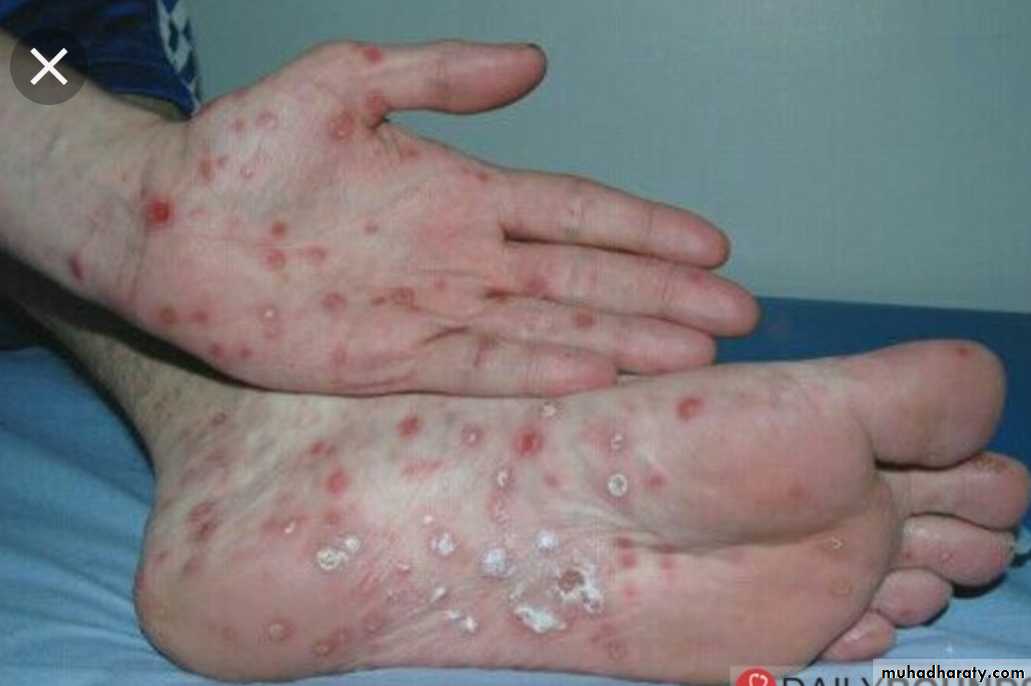 Infection
