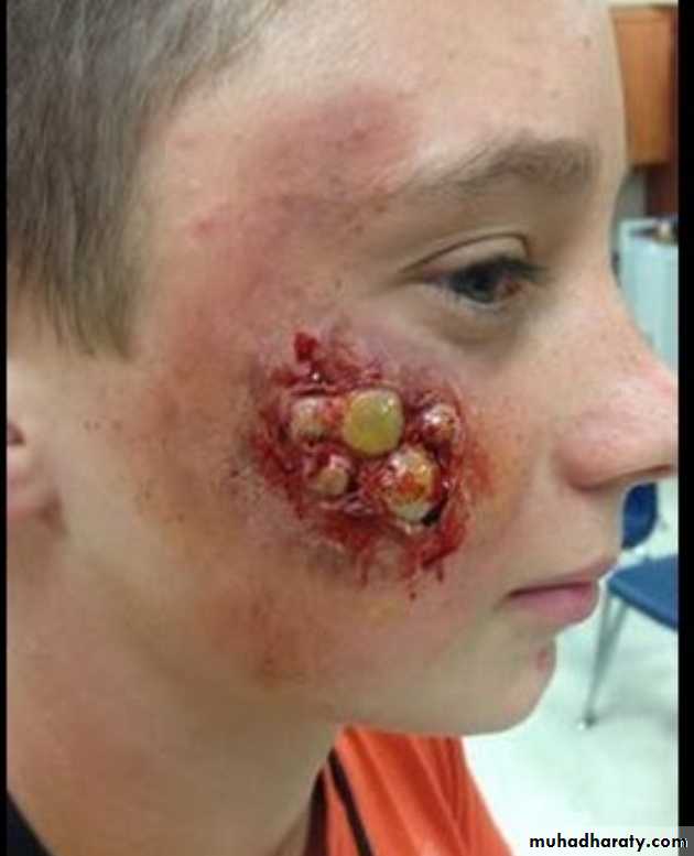 Infection