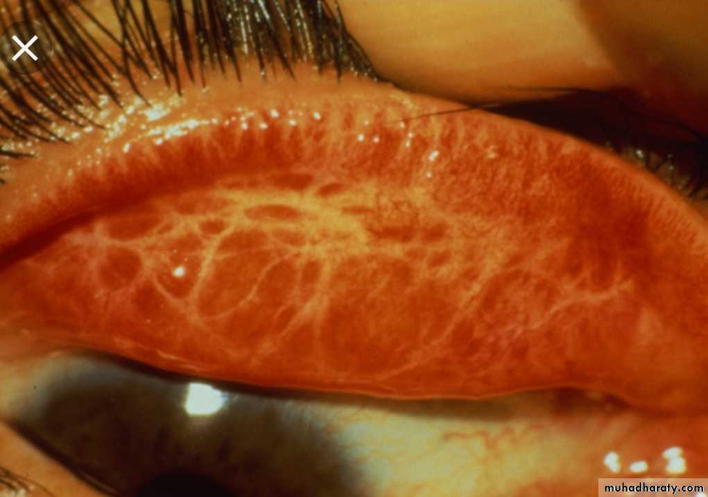 Infection