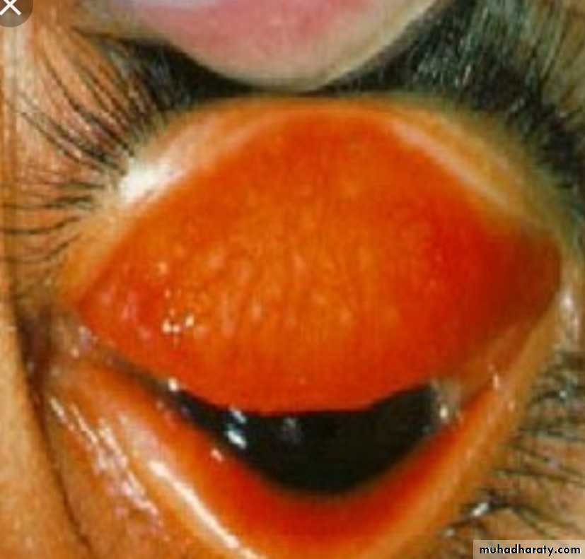 Infection
