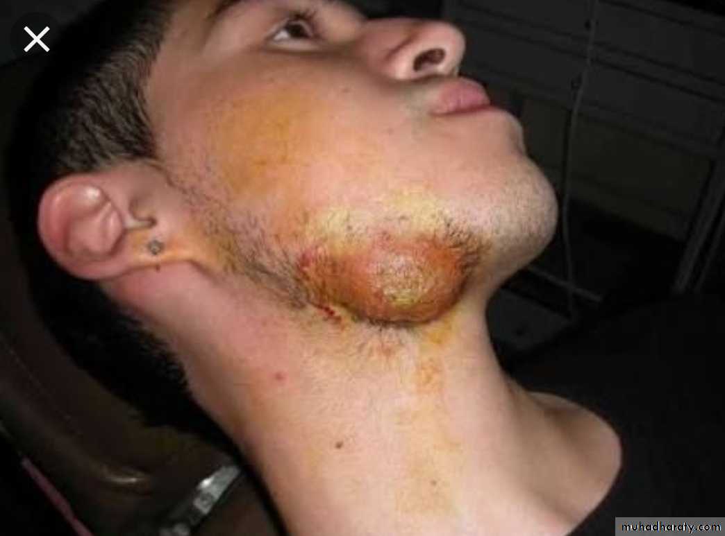 Infection