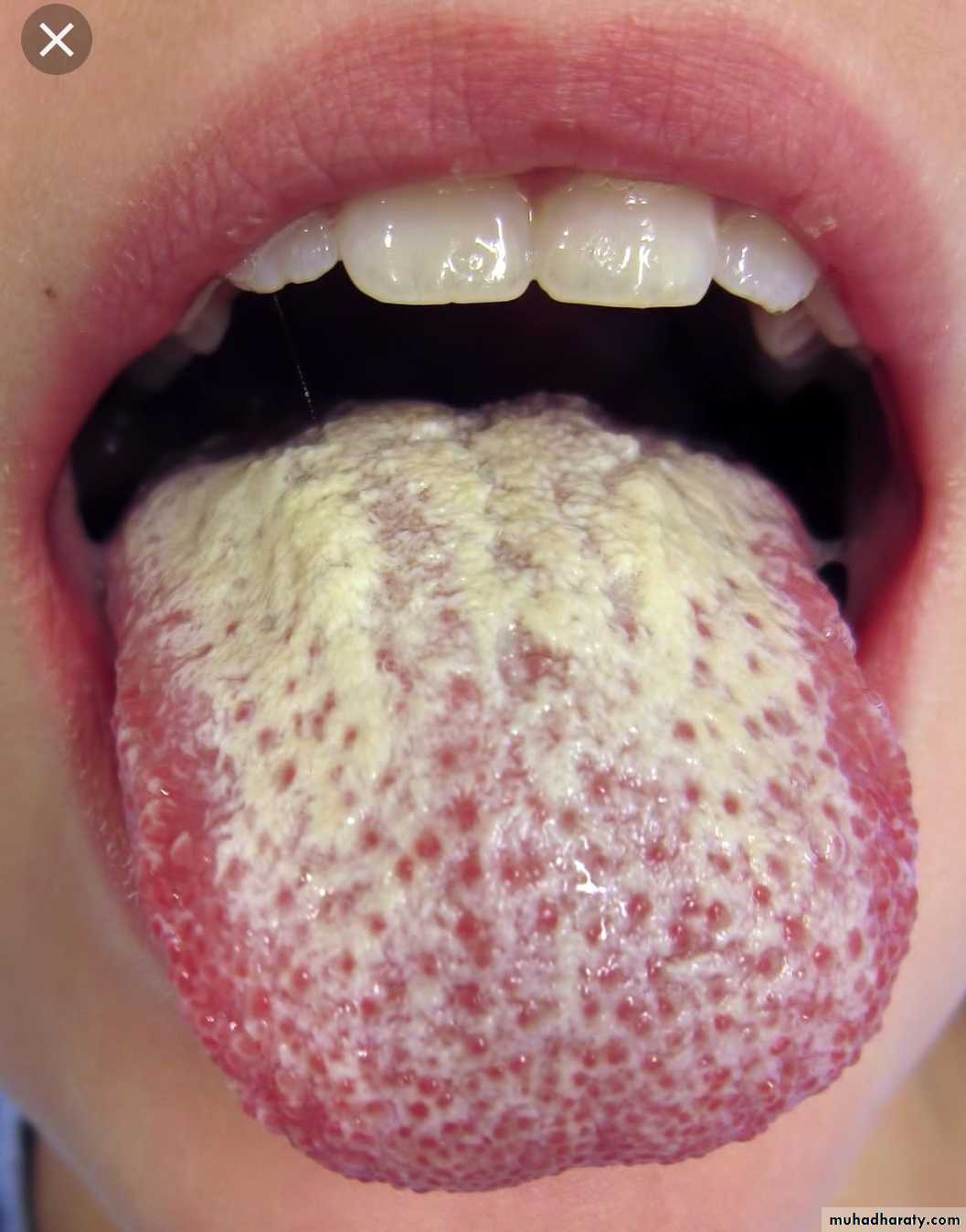 Infection