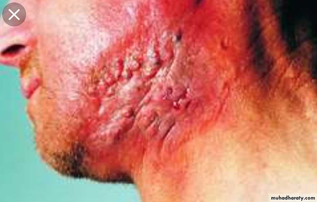 Infection
