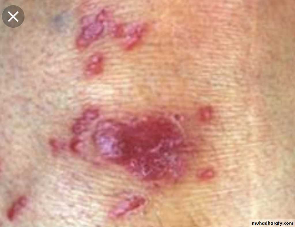 Infection