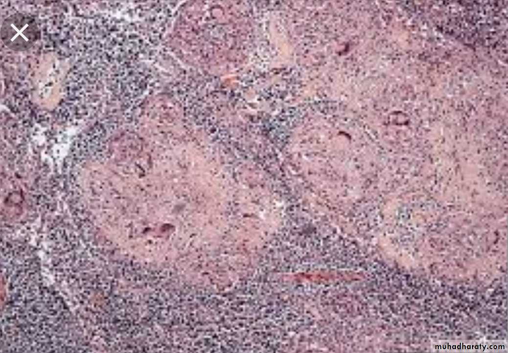 Infection