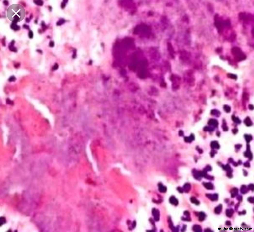 Infection