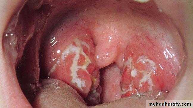 Streptococcus