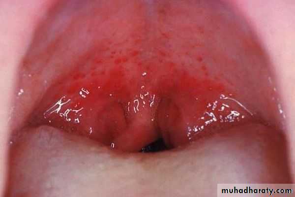 Streptococcus