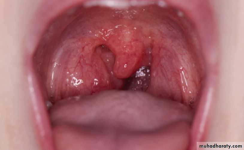 Streptococcus
