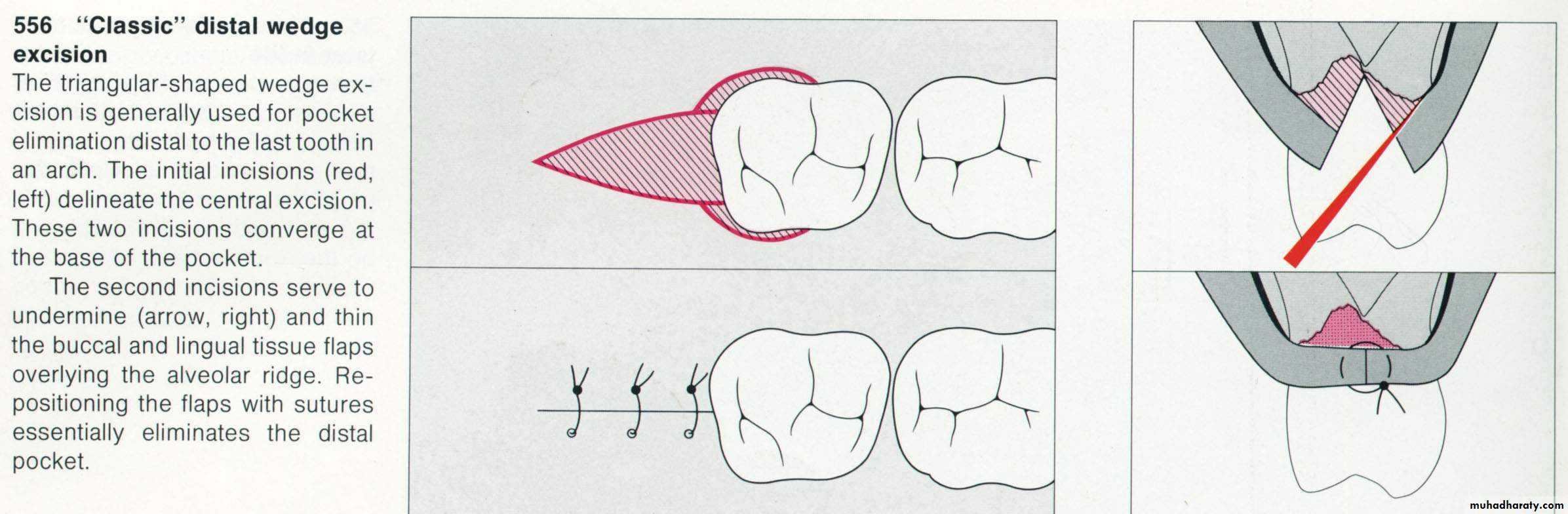corrective phase .2