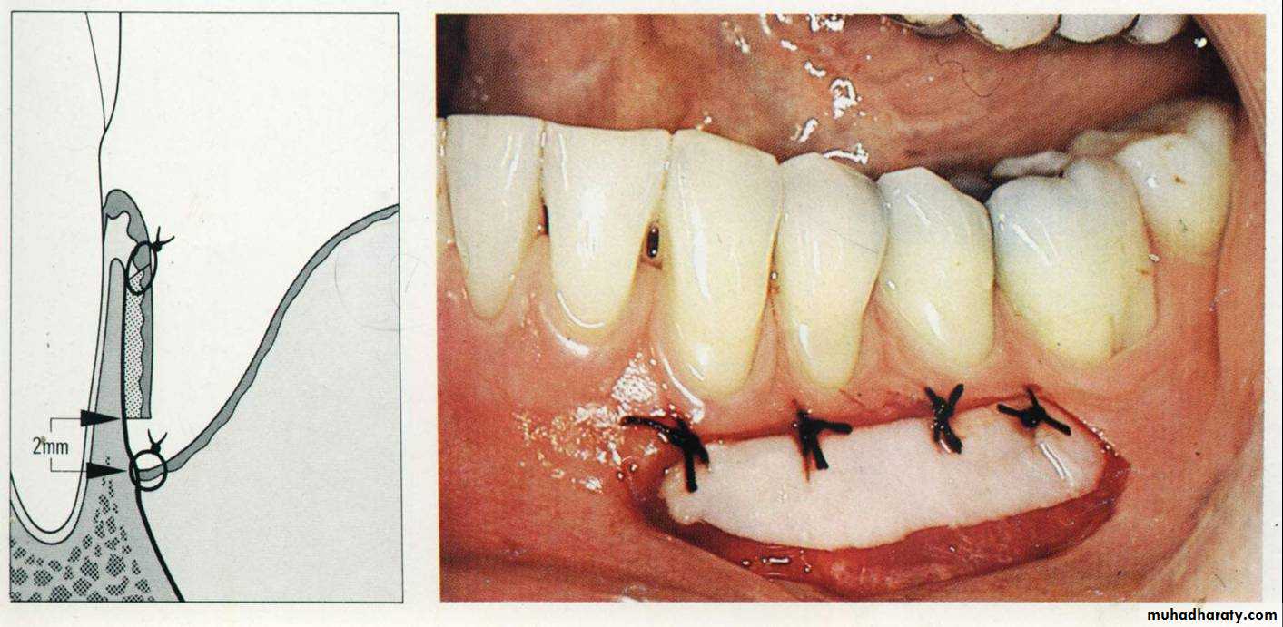 corrective phase .2