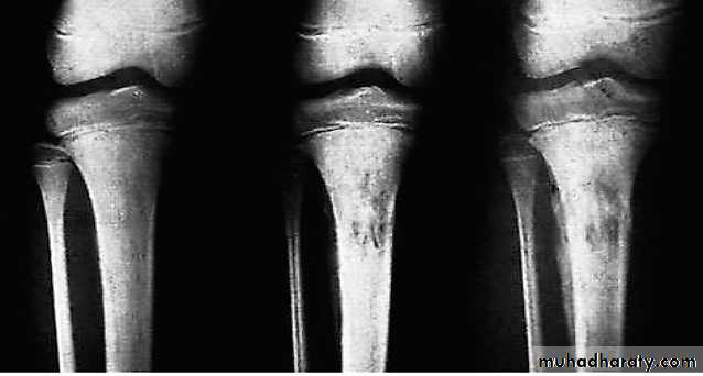 Osteomyelitis