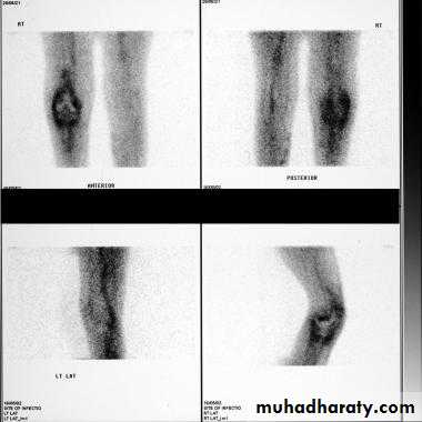 Osteomyelitis