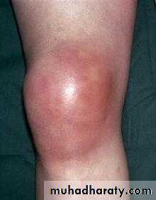Osteomyelitis