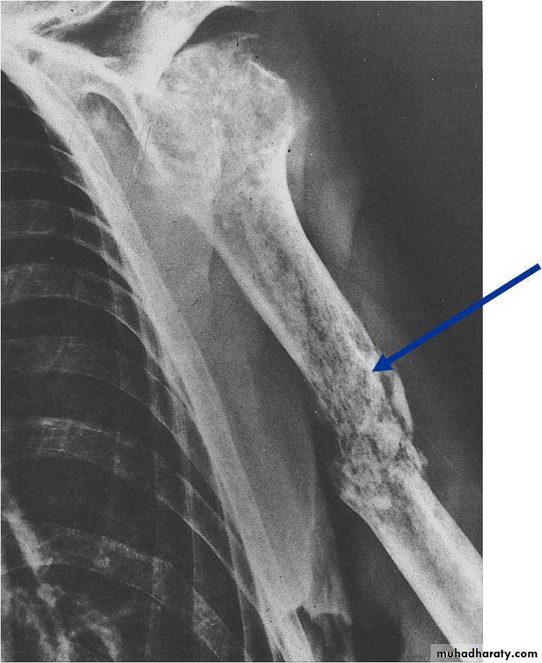 Osteomyelitis