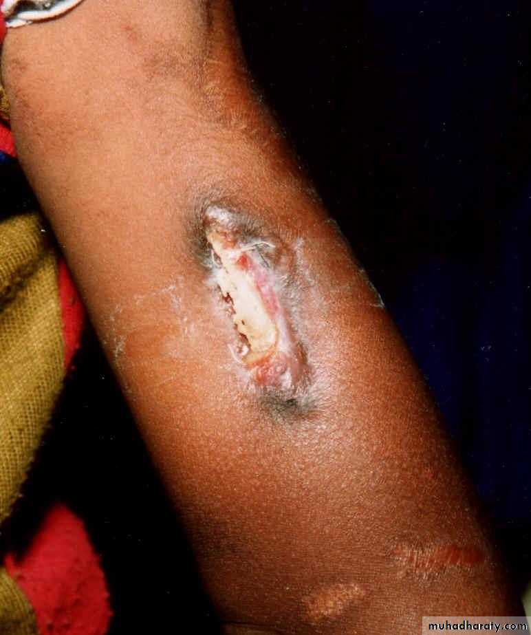 Osteomyelitis