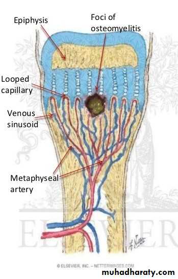 Osteomyelitis