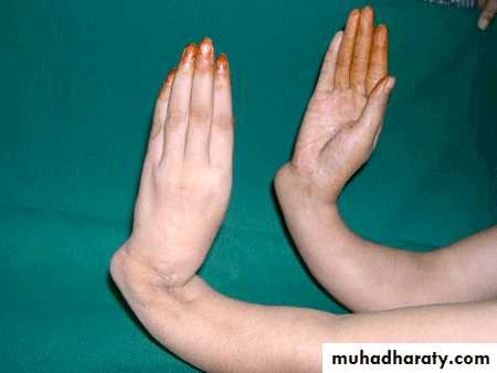 Osteomyelitis