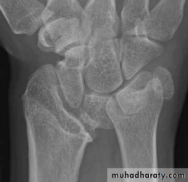 Osteomyelitis